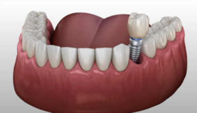 Single Tooth Implants